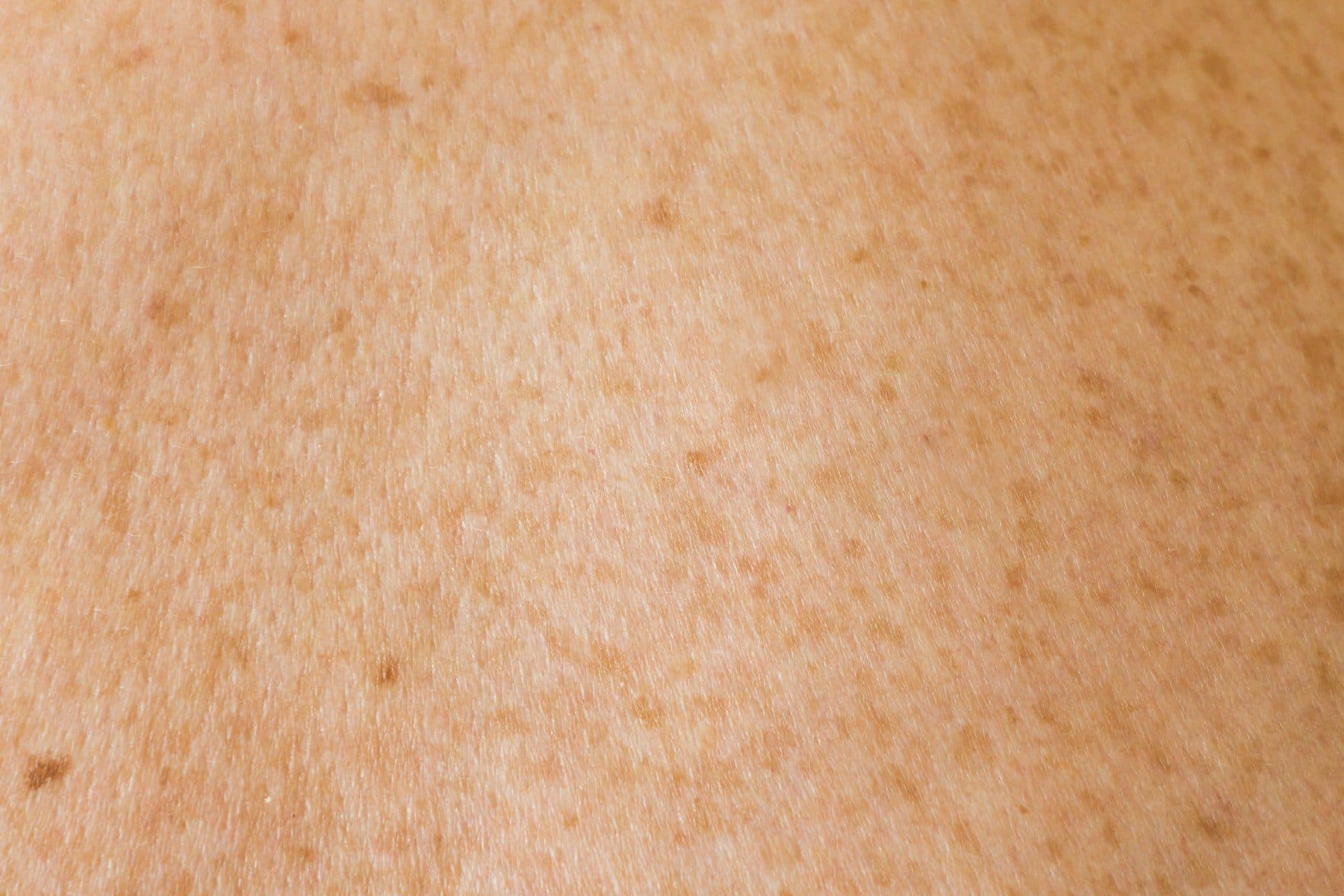 Textura de piel con pecas y manchas solares
